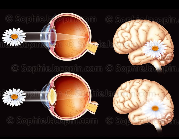 VISION AVEC CATARACTE – Image 2