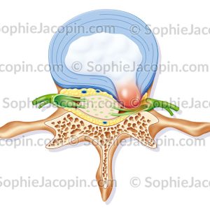 HERNIE DISCALE
